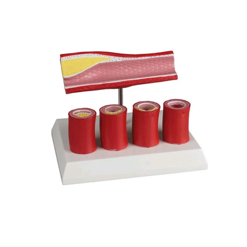 Erler Zimmer Arterienmodell, 4 Schnitte, Verengungen durch Plaque
