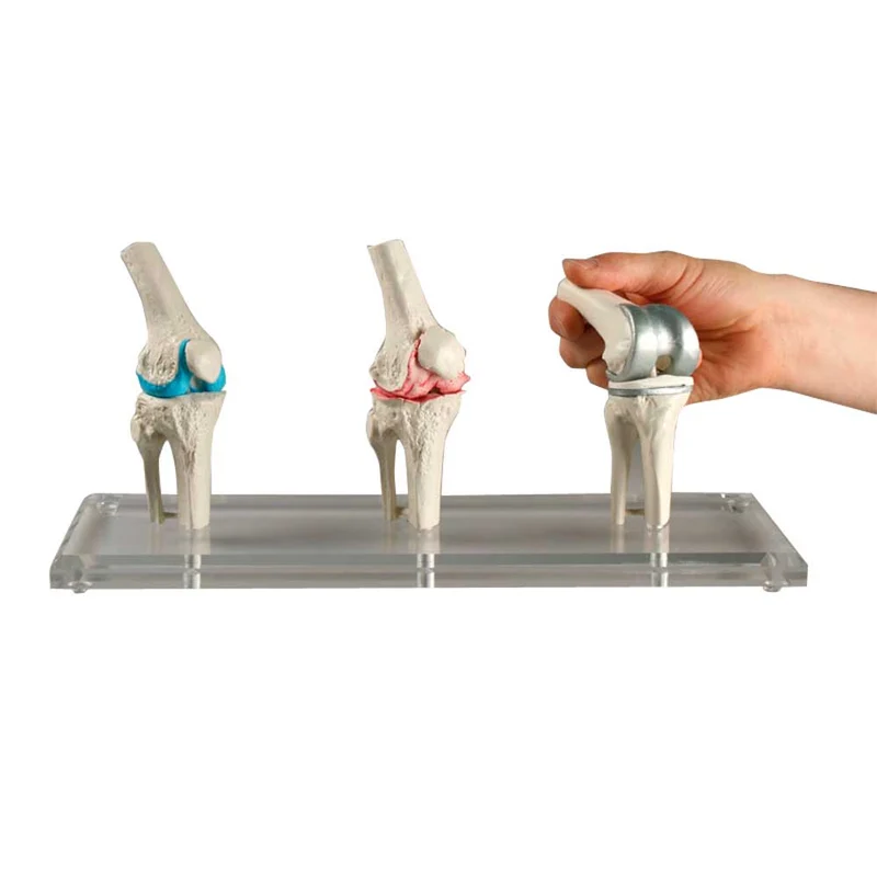 Erler Zimmer Knie-Implantat-Modell, 3 Stck, gesund/erkrankt/Implantat