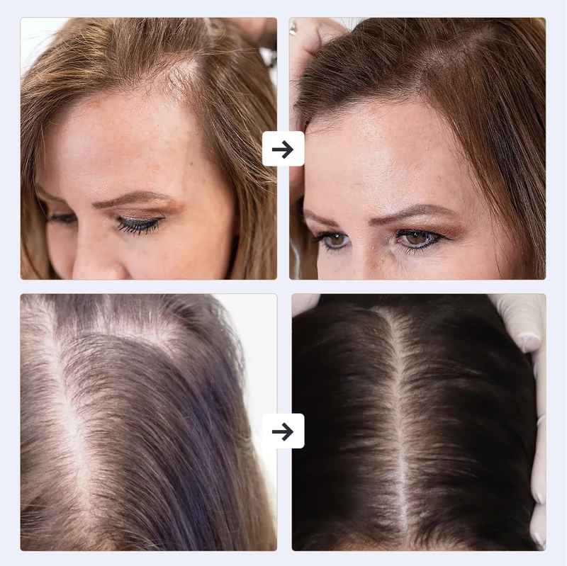 GESS Dars High-Frequency Massager Original Darsonval for Hair Growth & Scalp Treatment