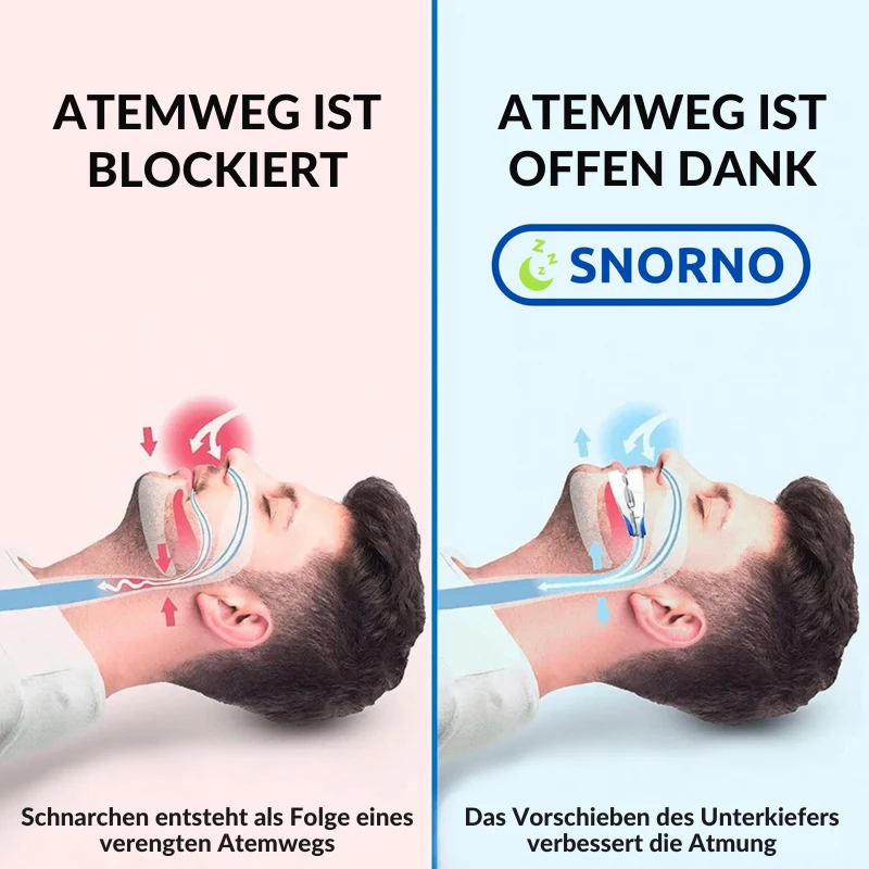 Anti Schnarch Mundstück – Verstellbares Schlaf-Mundstück mit Ergonomischer Passform